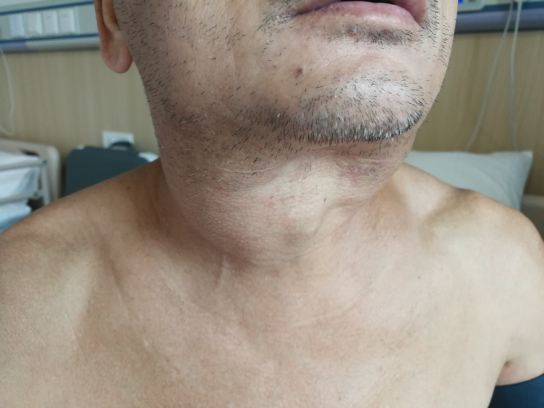 前海人寿广西医院耳鼻咽喉科成功为极罕见的马德龙综合征患者实施手术