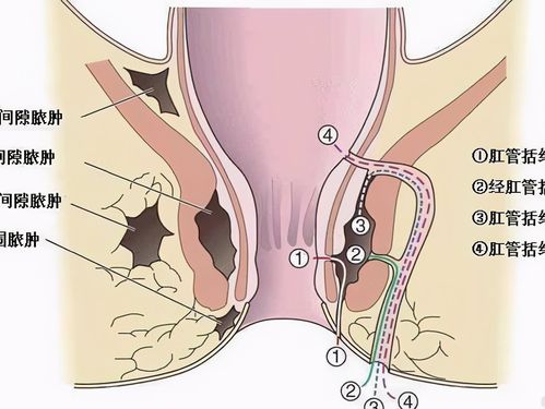 肛瘘手术到底有多痛?为什么很多患者宁愿选择不治疗?
