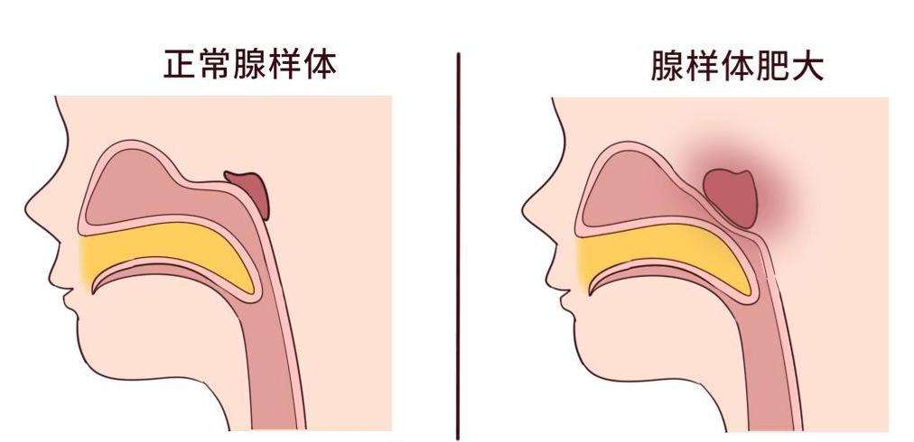 腺样体肥大,中医是怎么治疗的?