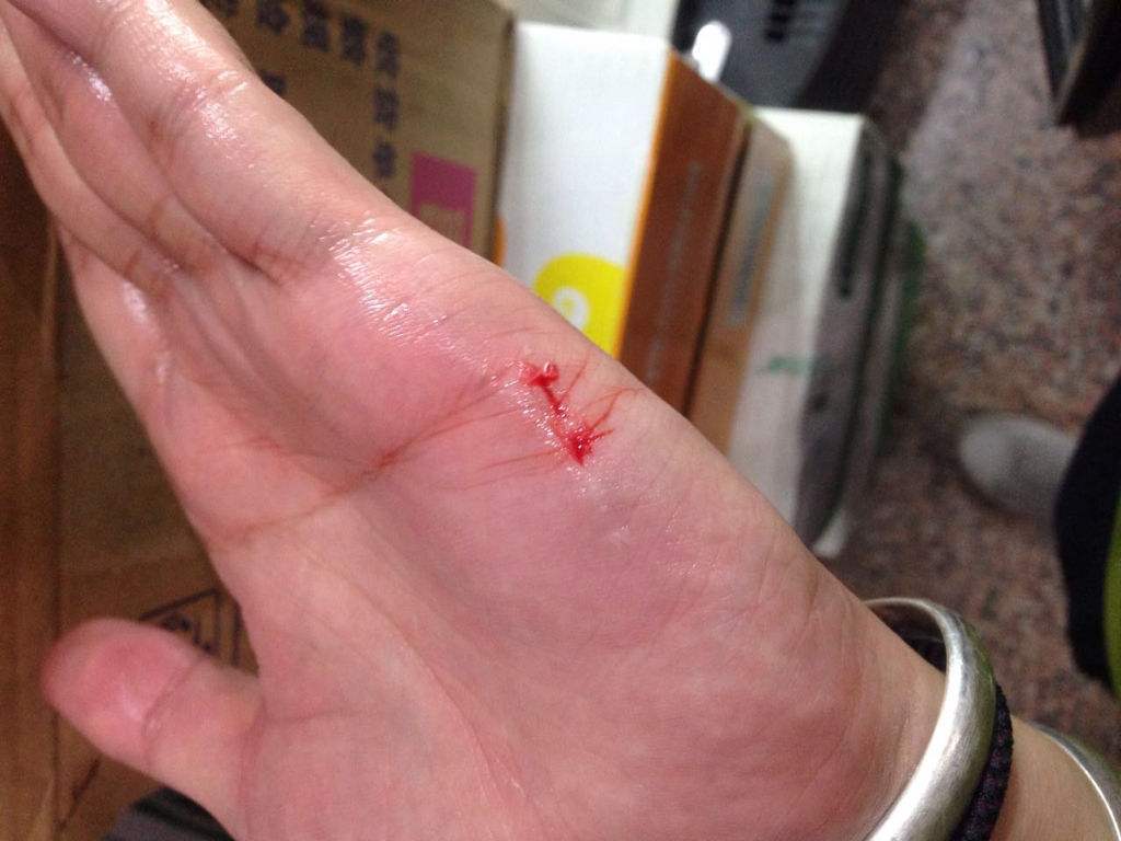 钩端螺旋体病建议及时就诊,属于传染病,病情严重需要住院治疗