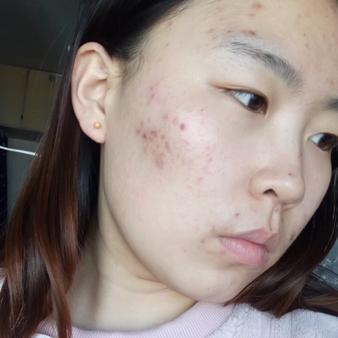 针清祛痘留下的痘印怎么消除 .@爱美的小琳的动态