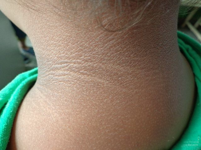 体内有癌,身体会有2处变黑,具体是指哪里?不妨来看看