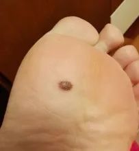 推荐速低头，找痣！知名医生：长在这些地方的都要切除！