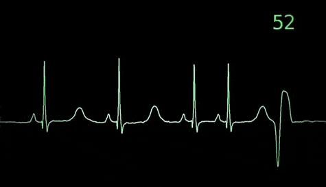 心梗与心脏骤停,傻傻分不清楚?