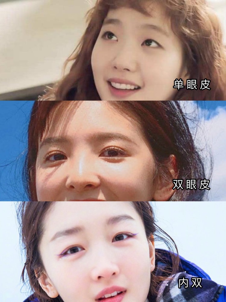 吸雕双眼皮是如何做的呢?有哪些优势?术后如何护理?