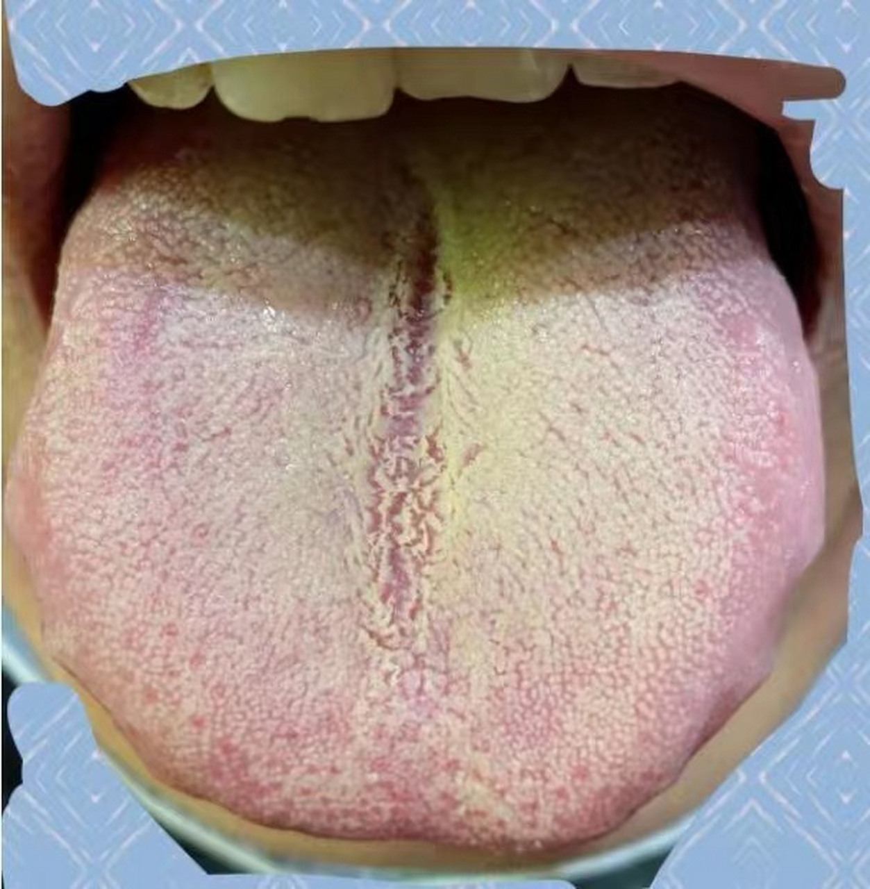 舌头中间有条沟图片