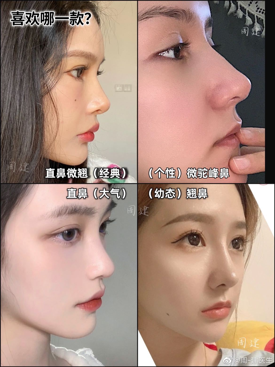 哑铃鼻基底,新术式不移位,郑州周建医生鼻整形专访