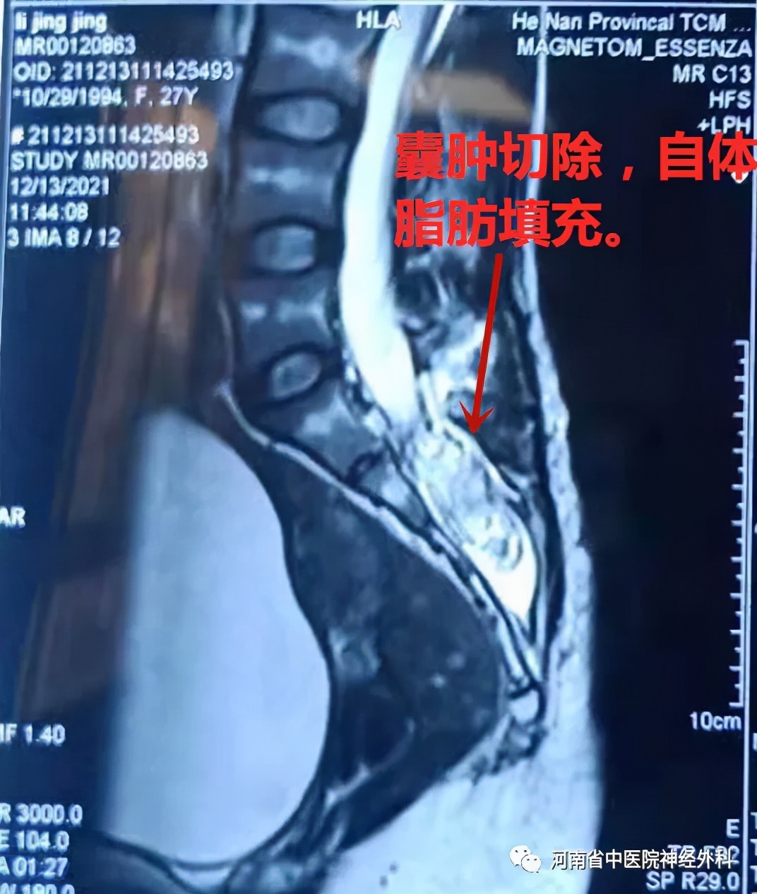 骶尾骨囊肿图片图片