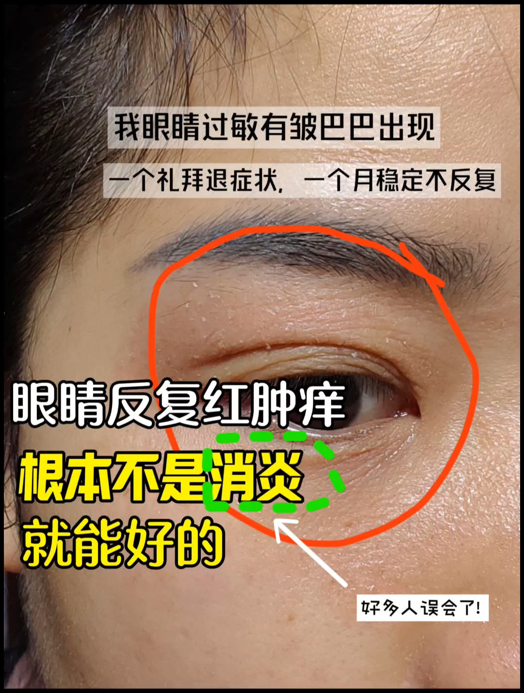 眼睛肿胀要警惕三种病百科在线