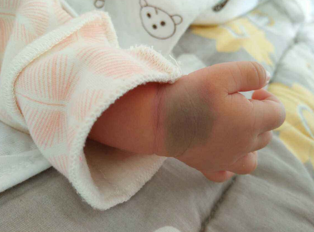 新生婴儿常见的7种胎记,这4种胎记值得注意,父母了解一下
