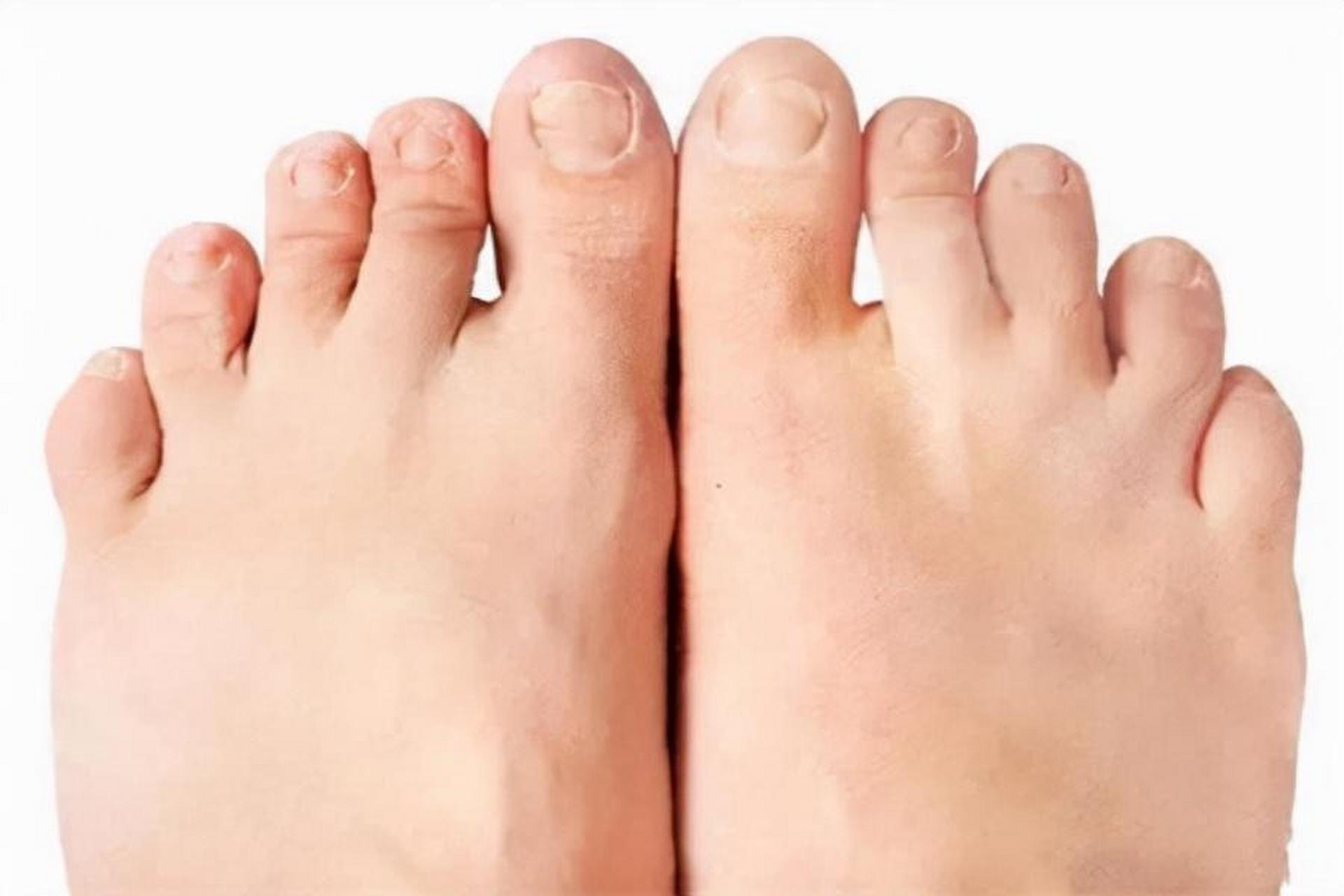 痛风# #痛风高尿酸#  典型的第一次痛风大多是单关节炎,多见于第一跖