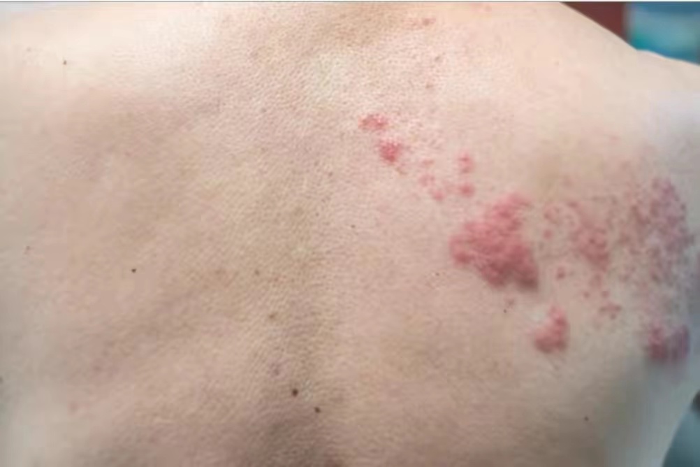 缠腰龙如刀割般令人疼痛难忍,竟是癌症前兆,是真相还是谣言吗?