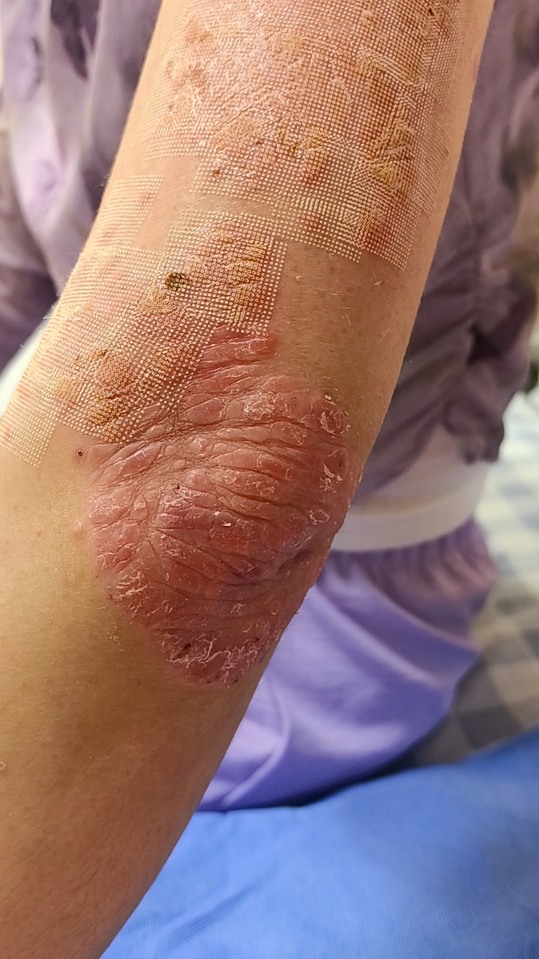 长期熬夜到凌晨3点,银屑病全身大爆发,一个月内长满全身