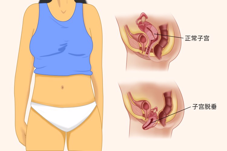 "阴挺"是什么病?主要原因是什么?该怎么治疗?一文解惑