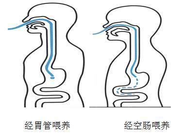 空肠营养管结构图图片