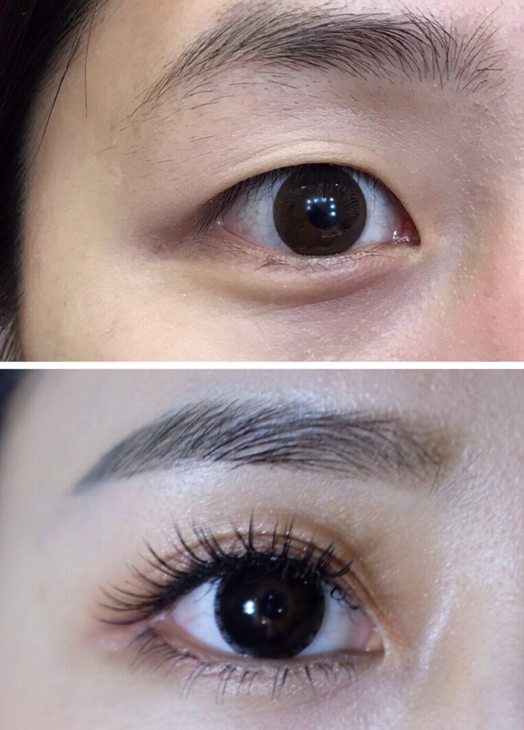 为何双眼皮手术这么受欢迎?你知道吸雕双眼皮的做法和好处吗?