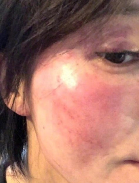 黄景瑜家暴前女友的脸上伤痕有清晰直线边缘,疑似点阵激光