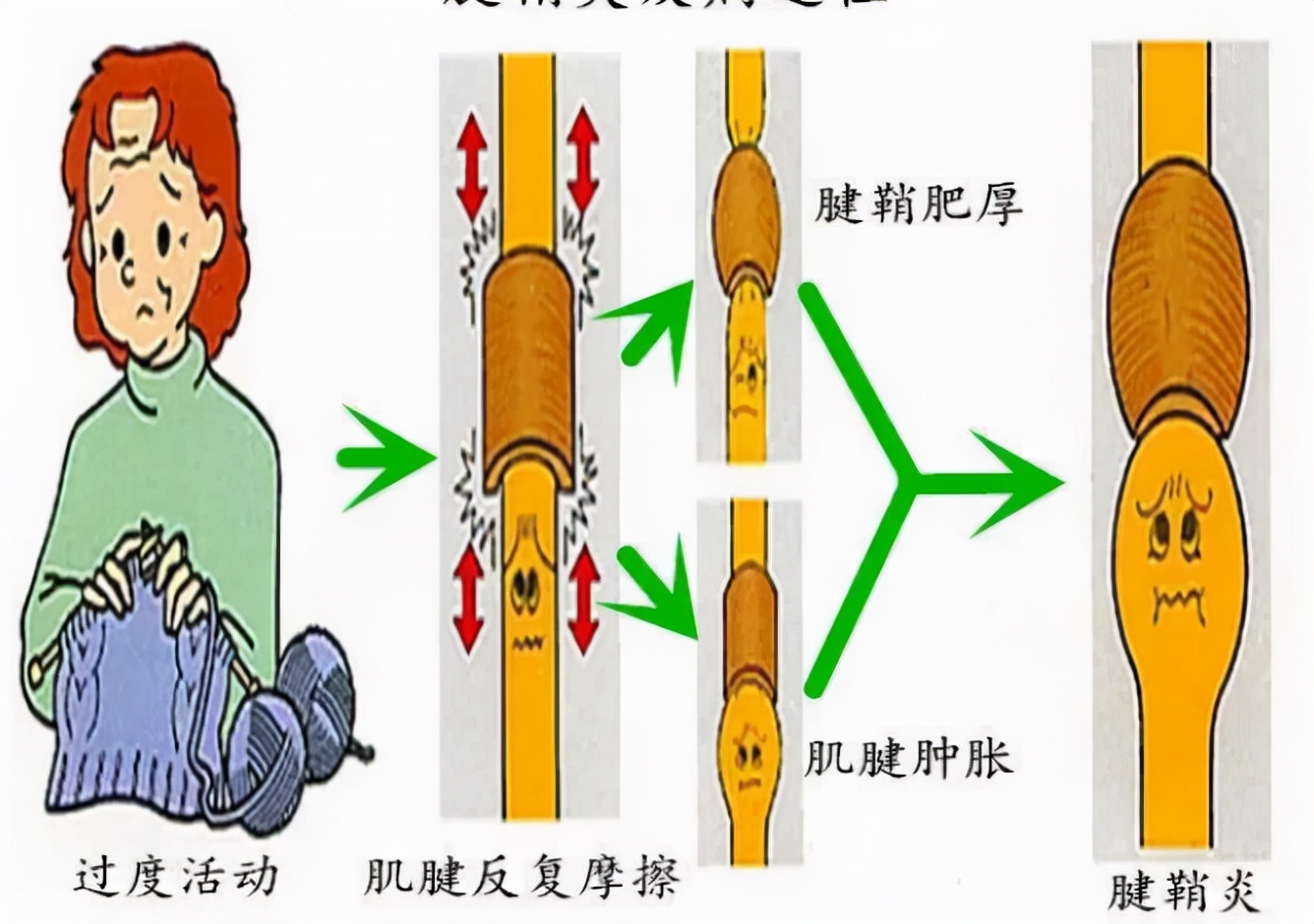 橈骨莖突狹窄性腱鞘炎,主要的臨床表現為橈骨莖突處疼痛