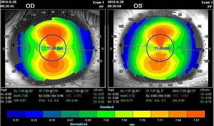 角膜塑形镜角膜地形图图片