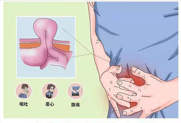 疝气怎么推上去图解图片