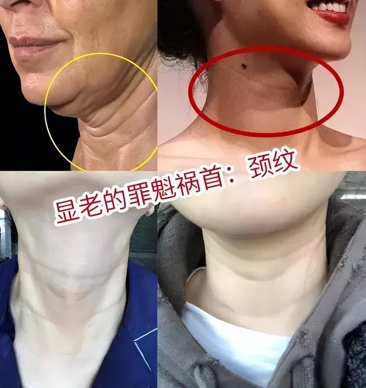 女人脖子出现"三条纹",有些人不在意,可有了颈纹真的很显老气