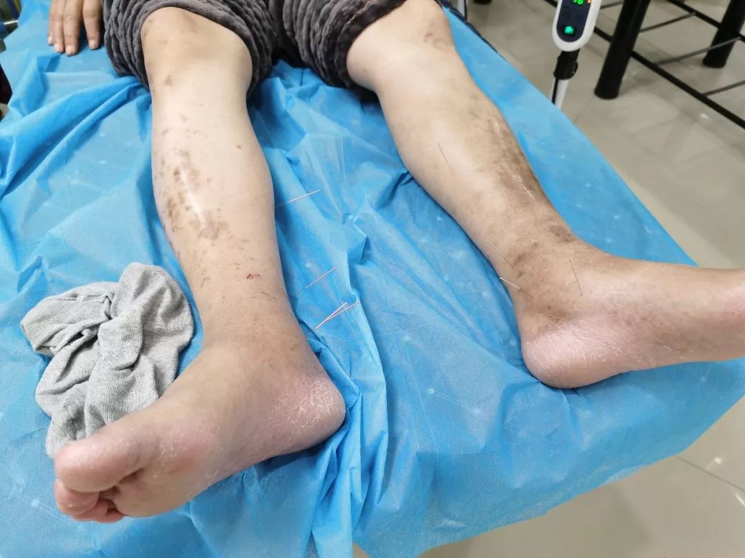 腿摔骨折了怎么治疗?福州老人在医院康复,身体情况逐渐好转