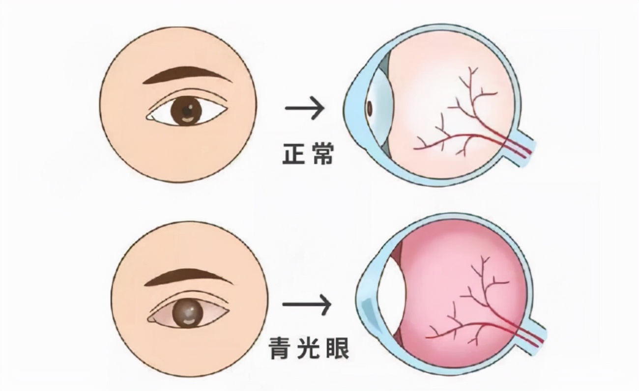 伴有虹膜睫狀體炎的繼發性青光眼,不會遺傳,可導致視力下降