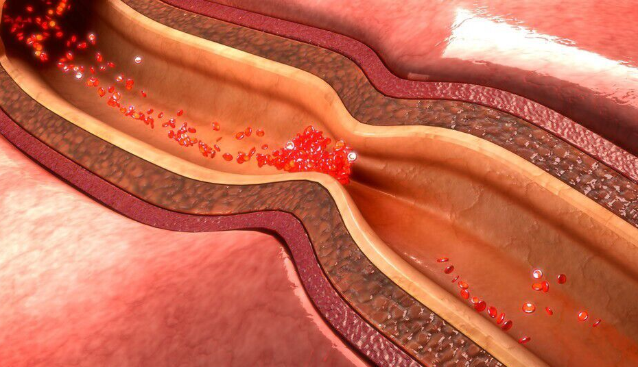 主动脉缩窄是以主动脉管腔狭窄为特征的心血管疾病,男性发病率高