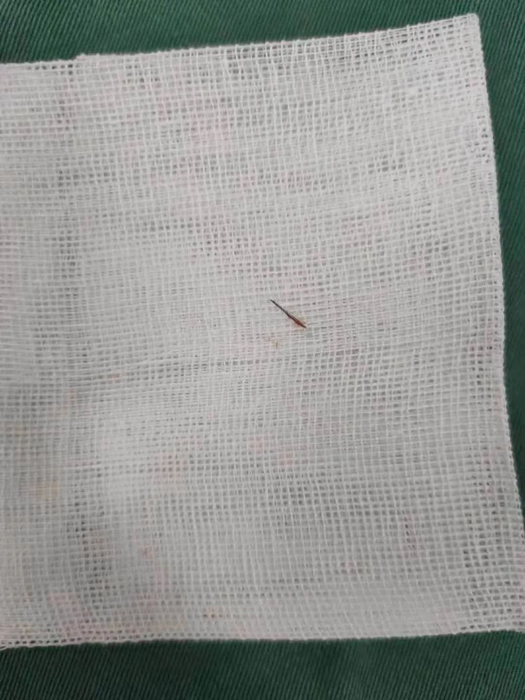 两名三岁男童接连针 插 腹中 江西省儿童医院紧急手术 医院汇 丁香园