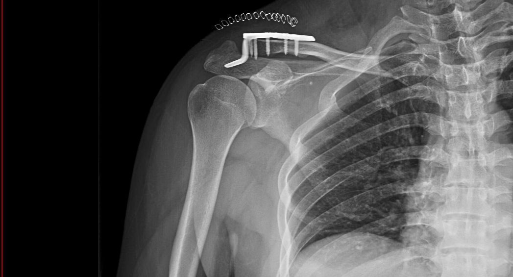 肩锁关节脱位的患者,基本有过外伤,按压局部,有明显的疼痛感