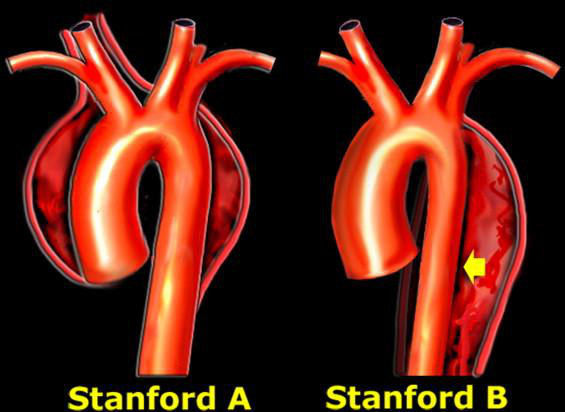 因为除了心梗,还有主动脉夹层