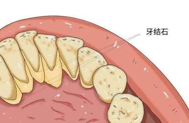 牙缝里的牙结石,怎么有效清除?医生:教你3个方法,轻松除牙垢