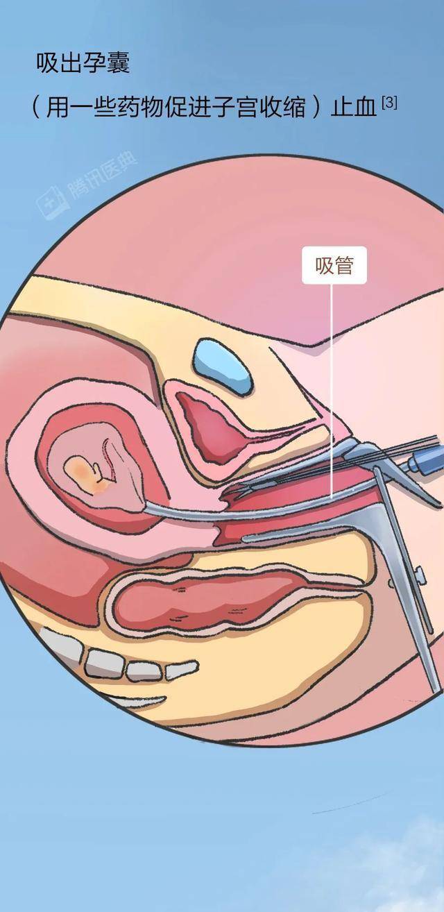 腾讯医典的警示 人流手术