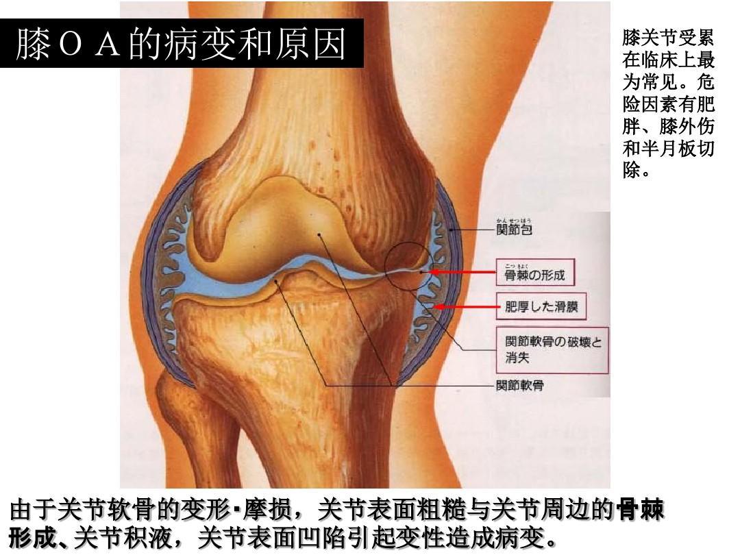 神經性關節病,會和膝關節囊腫,以及類風溼性關節炎等疾病混淆