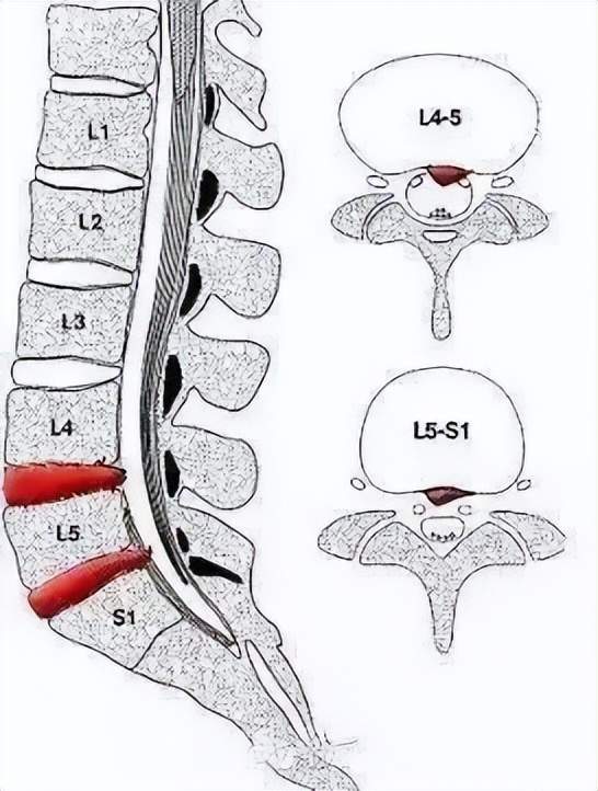 l5s1椎间盘突出示意图图片