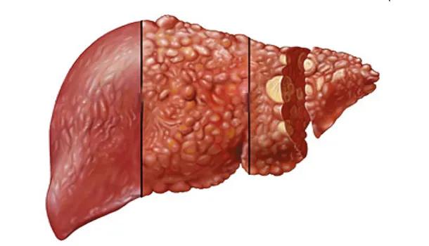 慢性乙肝,一定要经过肝硬化阶段,才能发展为肝癌吗?