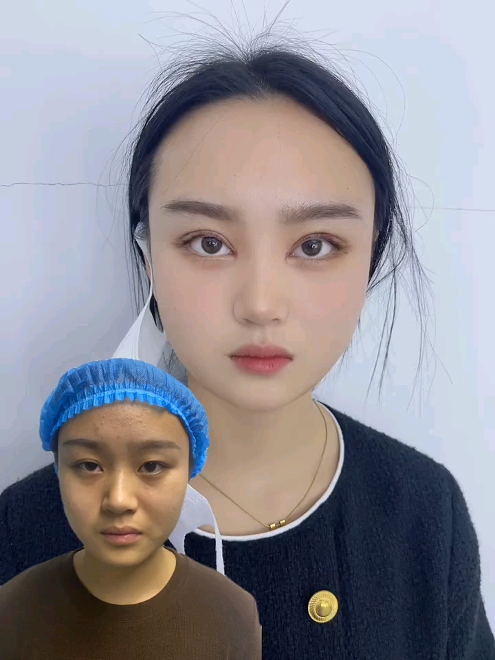 全切双眼皮,提肌第七天拆线