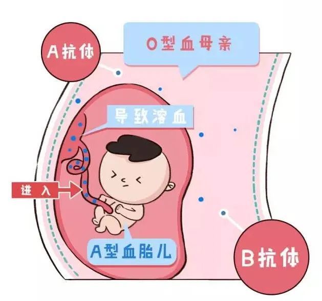 o型血的孕妈注意啦要警惕宝宝abo溶血