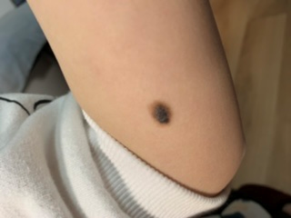 推荐速低头，找痣！知名医生：长在这些地方的都要切除！