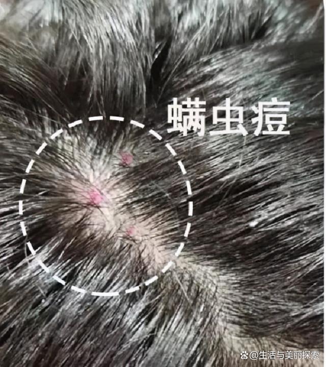 床上螨虫成团?教你1个蠢方法