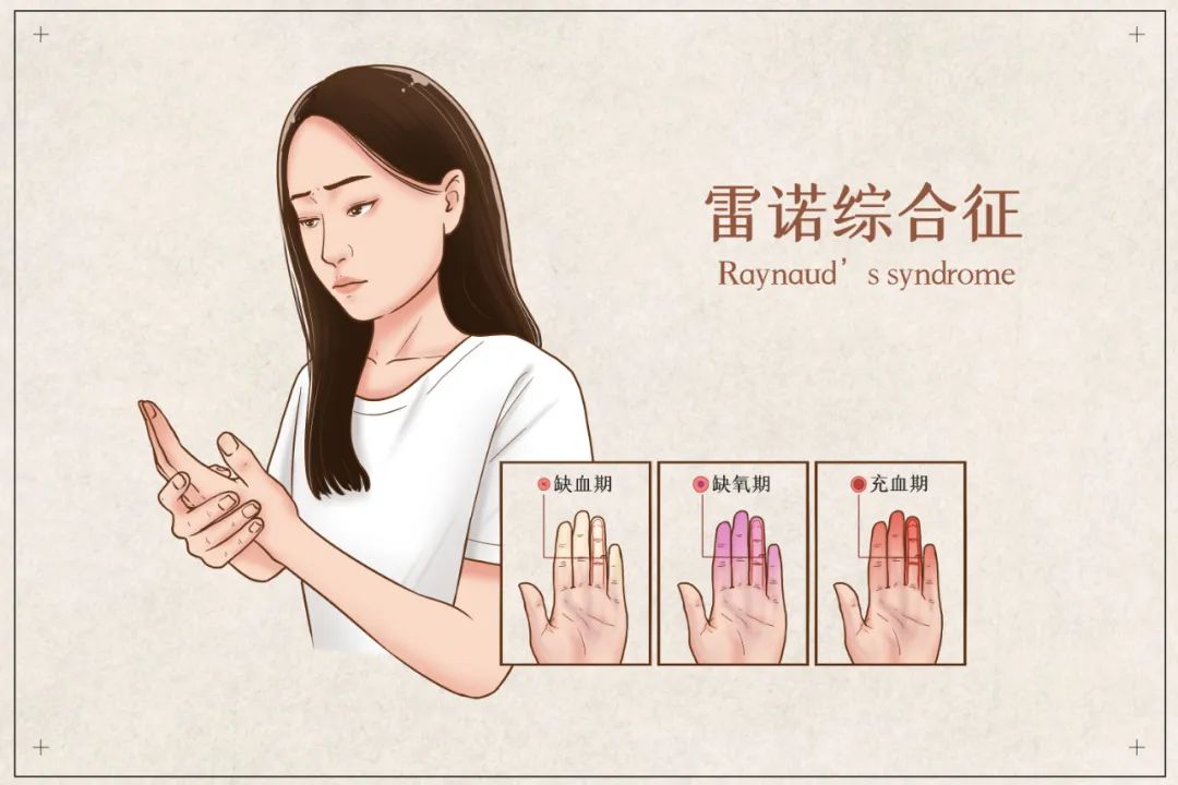 遇冷手指发冷,发白,麻木无力?或是患上雷诺综合征?