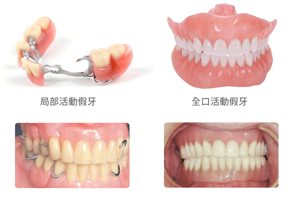 而文章开头的那种容易滑脱出来的就是活动义齿.