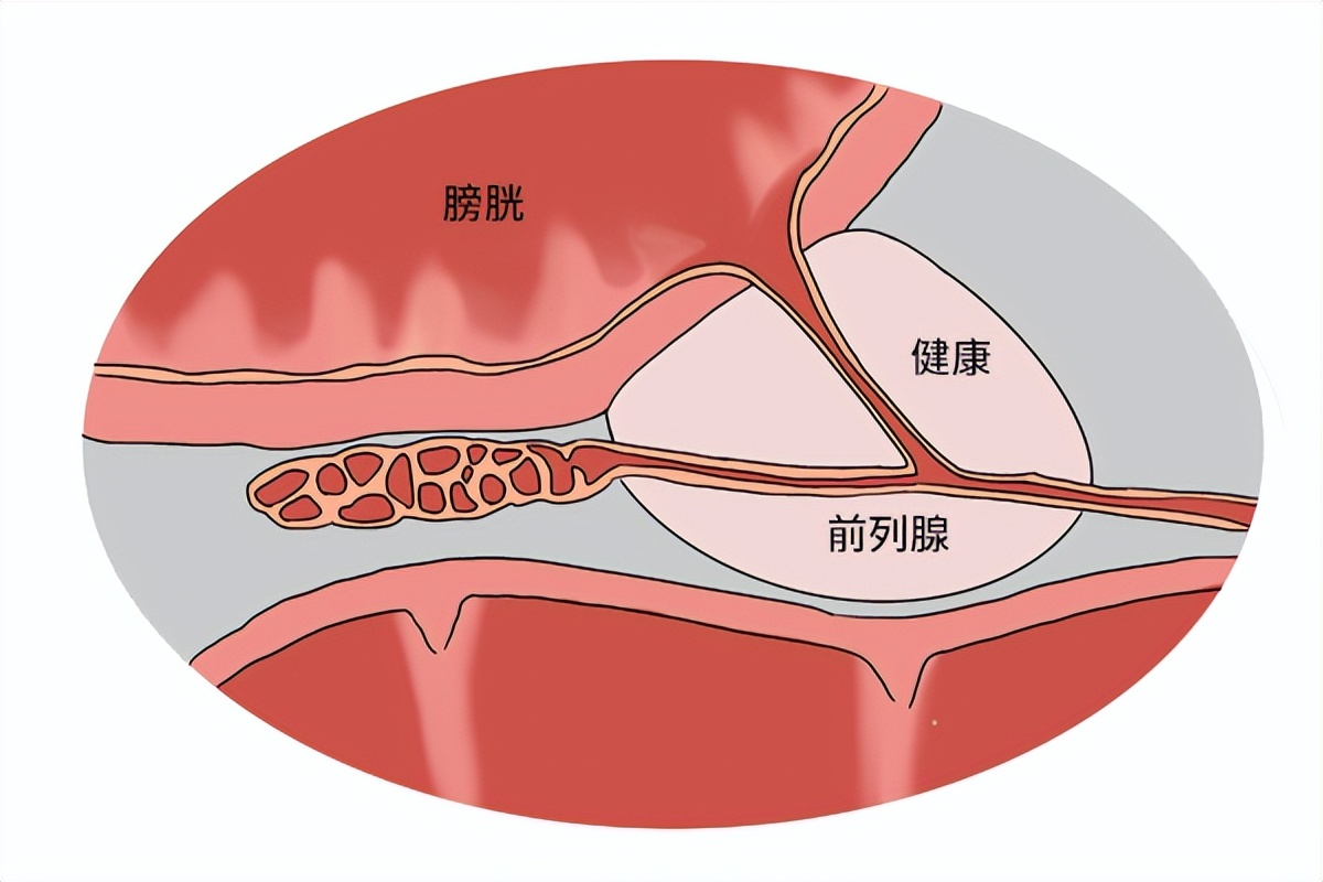 前列腺增生有哪些症状?有哪些治疗方法?40岁以上男性多了解