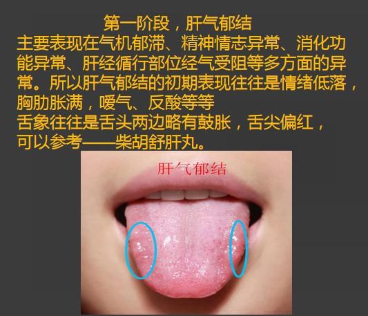 看看舌苔,你有沒有肝鬱的情況?