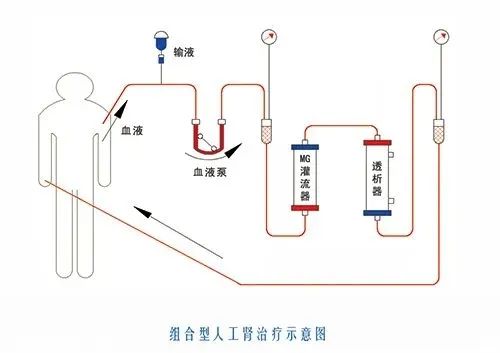 血液灌流安装图图片