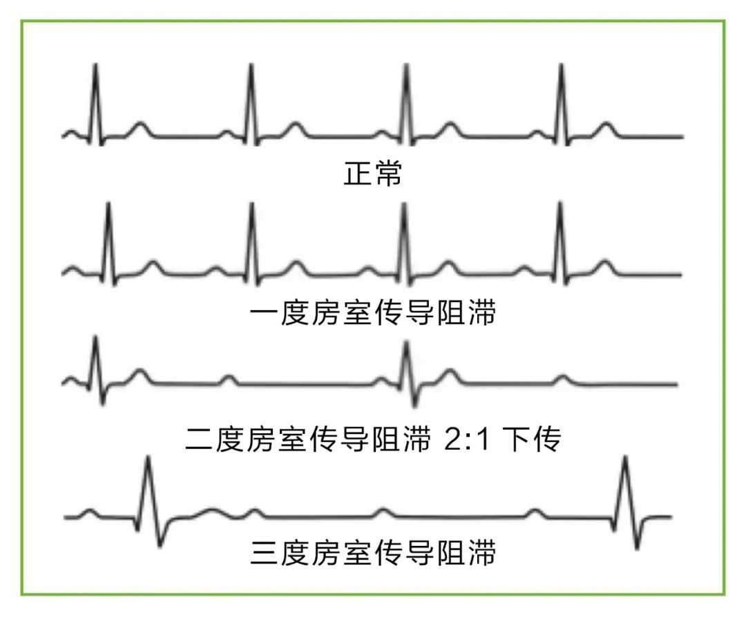 高度房室传导阻滞导致头晕昏倒