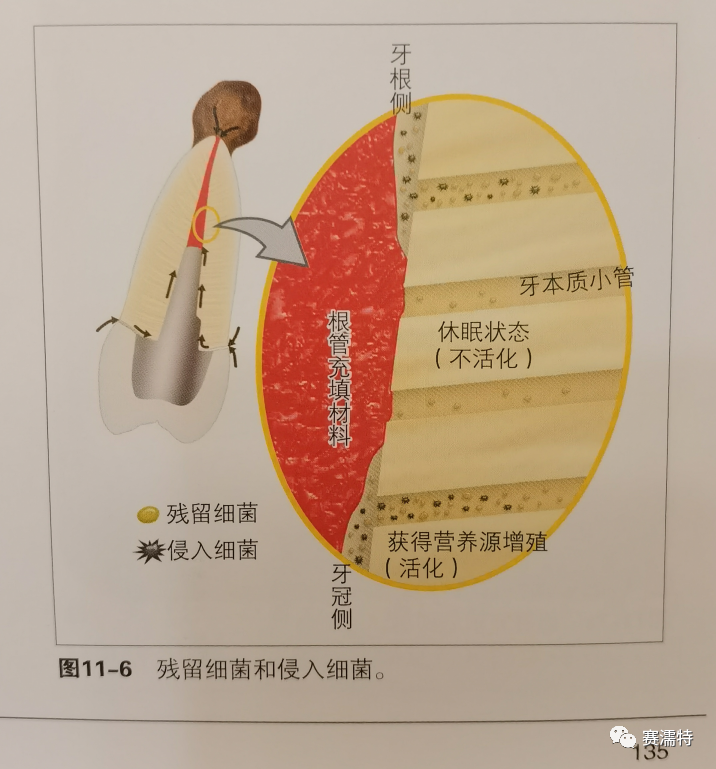聊一聊|c-root sp进入牙本质小管内发生的旅程!