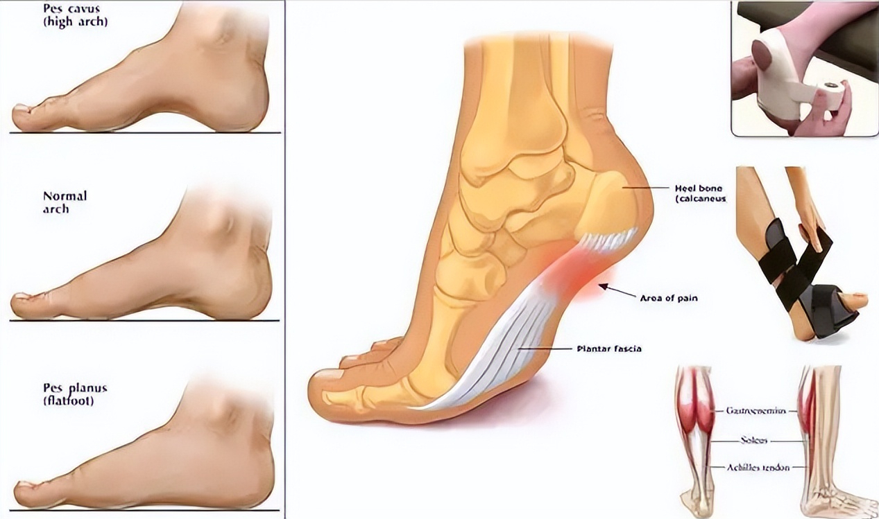 趾腱筋膜炎的位置图片图片