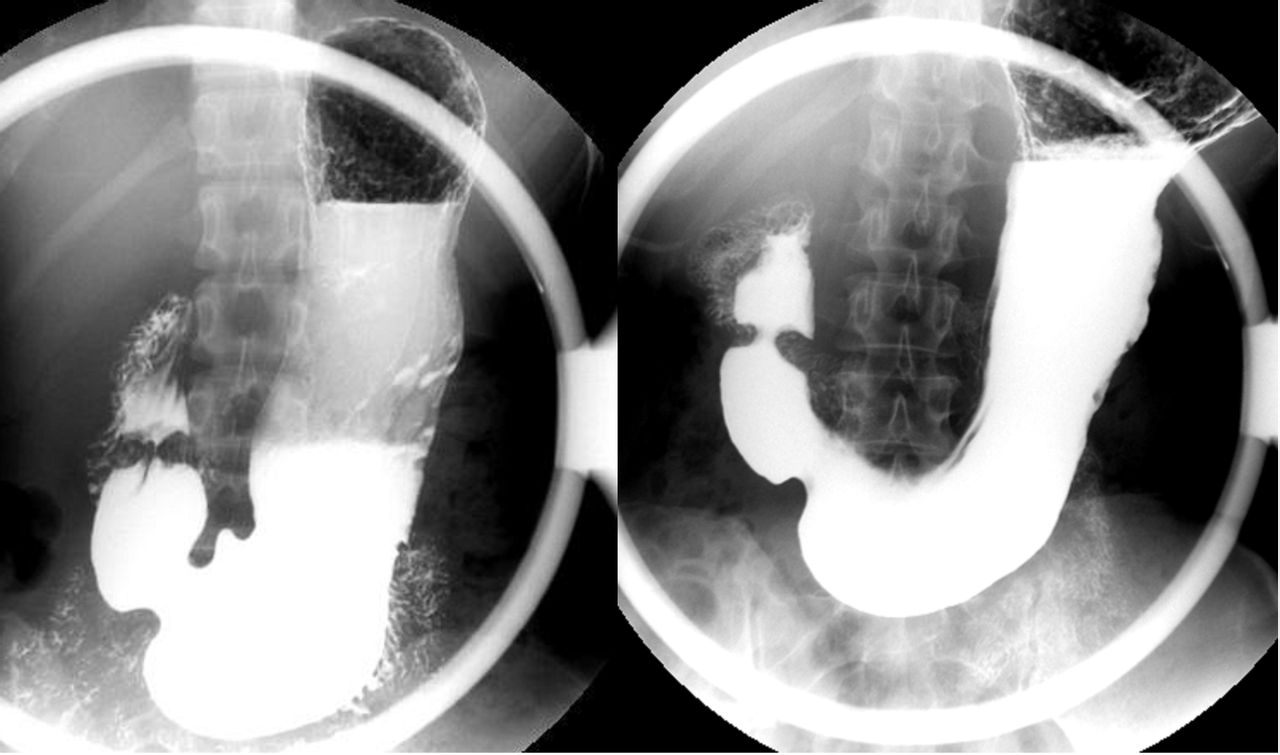 吃着阿司匹林或氯吡格雷,出现便血就是药物副作用吗?当心长东西