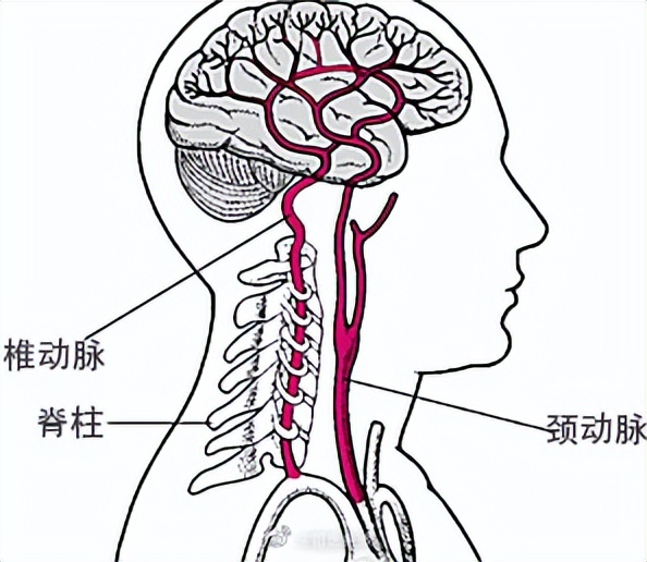 脑梗死位置图图片